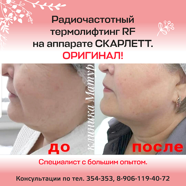 Радиочастотный термолифтинг RF на аппарате СКАРЛЕТТ - ОРИГИНАЛ!